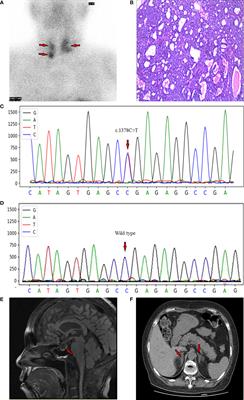 A MEN1 Patient Presenting With Multiple Parathyroid Adenomas and Transient Hypercortisolism: A Case Report and Literature Review